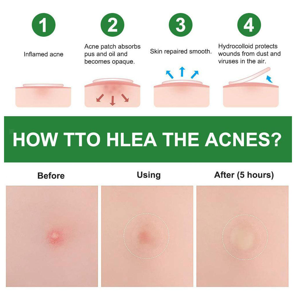 24Pcs Hydrocolloid Acne Stickers Clear Invisible Facial Spot Face Skin Care