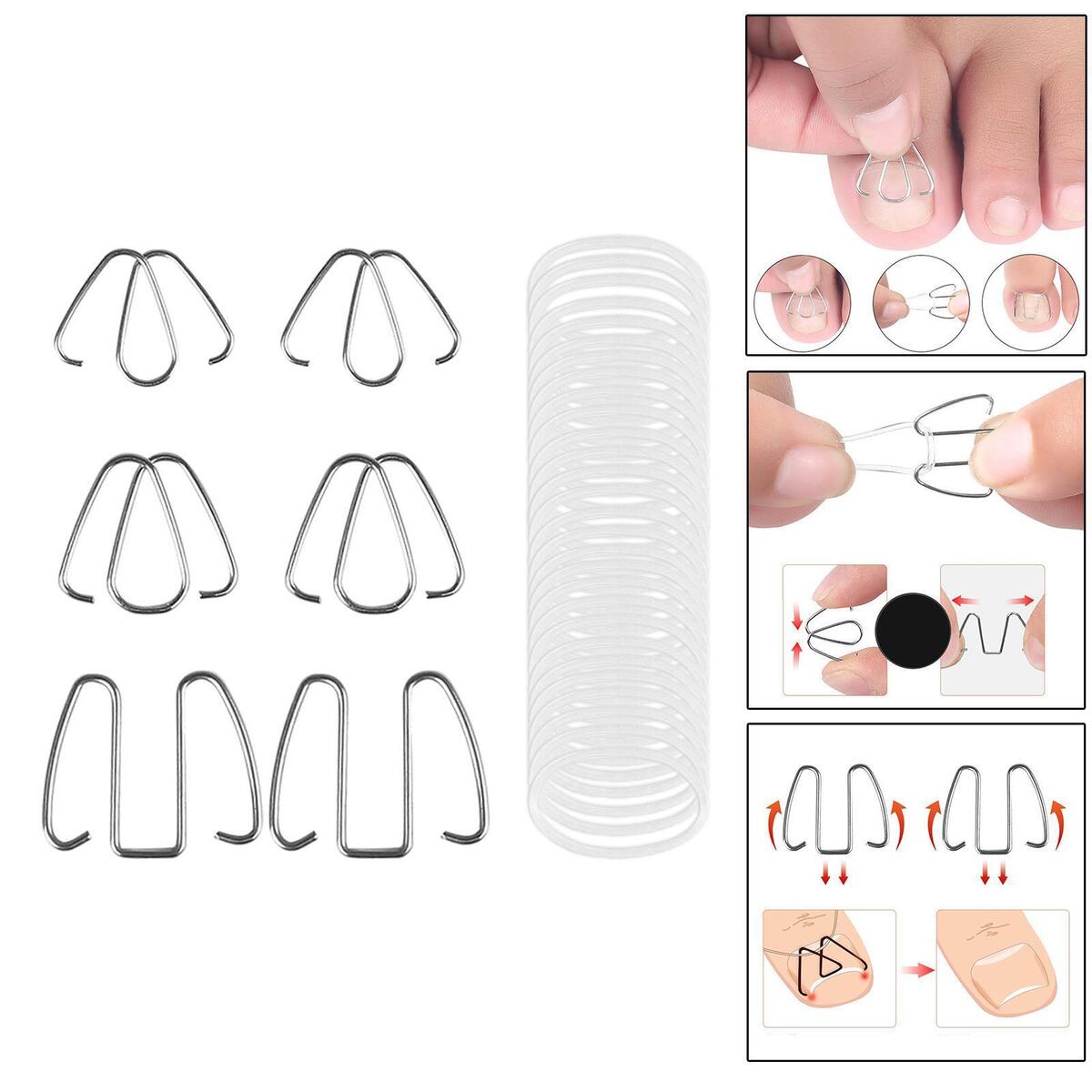 6Pcs Ingrown Toe Nail Correction Wire Paronychia Recovery Relieve Foot Pressure