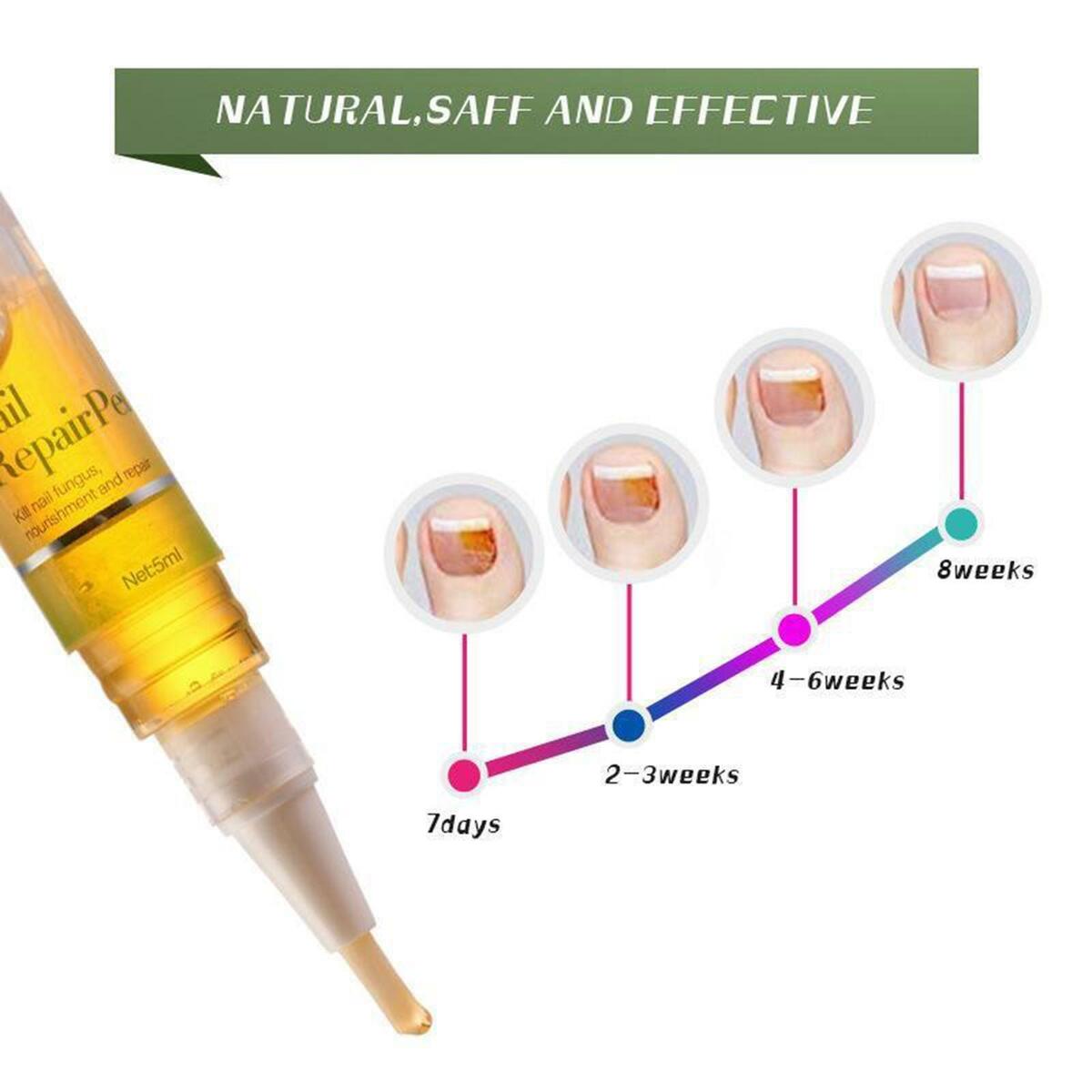 Nail   Treatment Toenail/Fingernail  Solution   Stop Nail