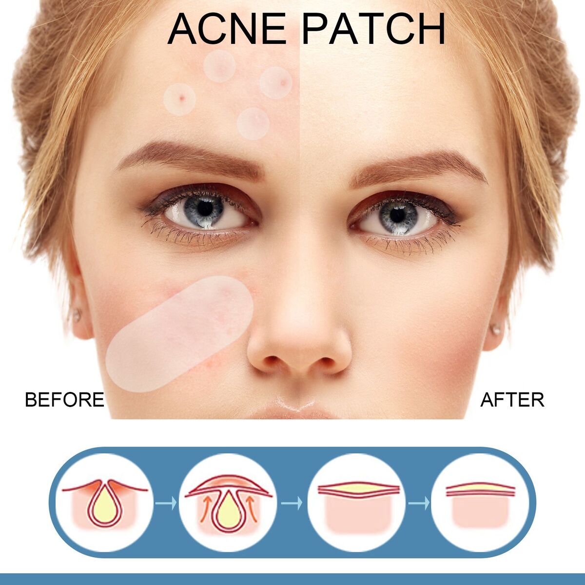 Master Skin Tag Remover Patch Ance Pimple Patches Acne Spot Treatment