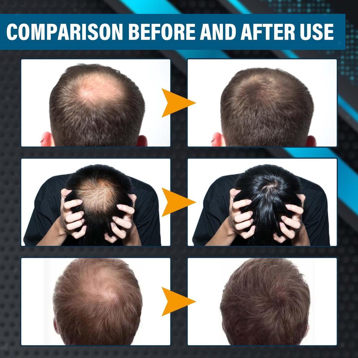 Hair Growth Essence Spray Anti Hair Loss Fast Grow for Prevent Hair Loss