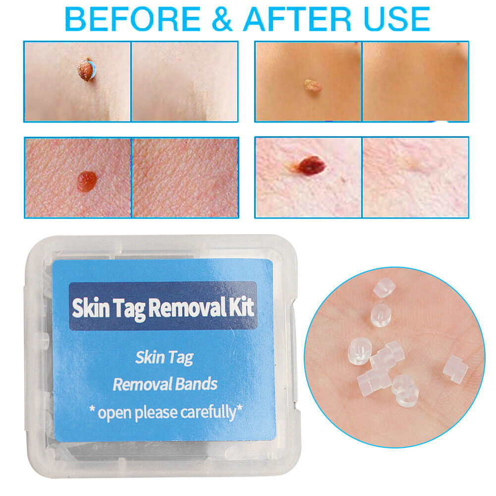 Skin Tag Removal Ring Rubber Bands Kit Acne Pimple Blemish Treatment Tools