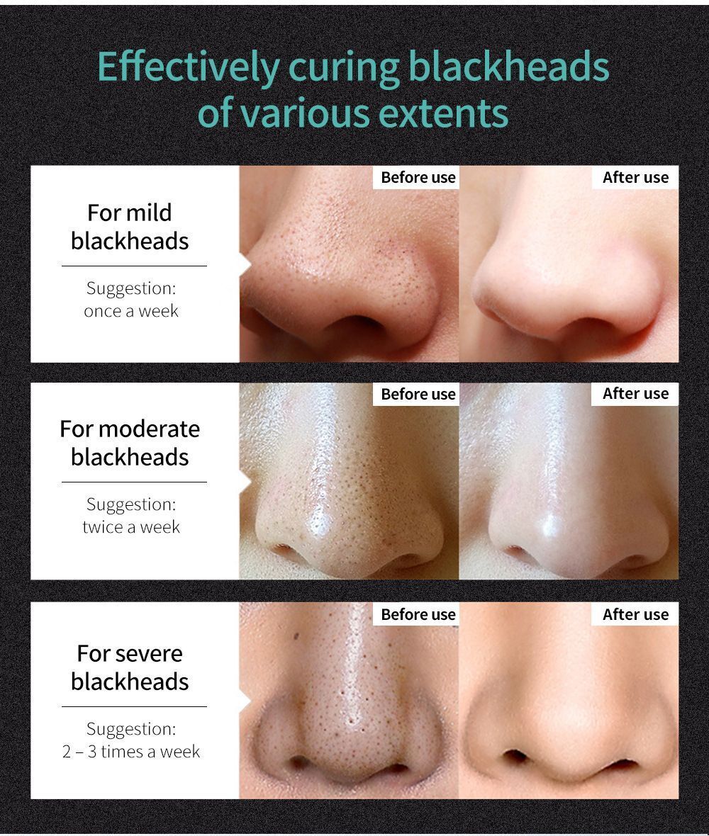 ment Skincare Face Care Bamboo Charcoal Blackhead Remover Remove black dots