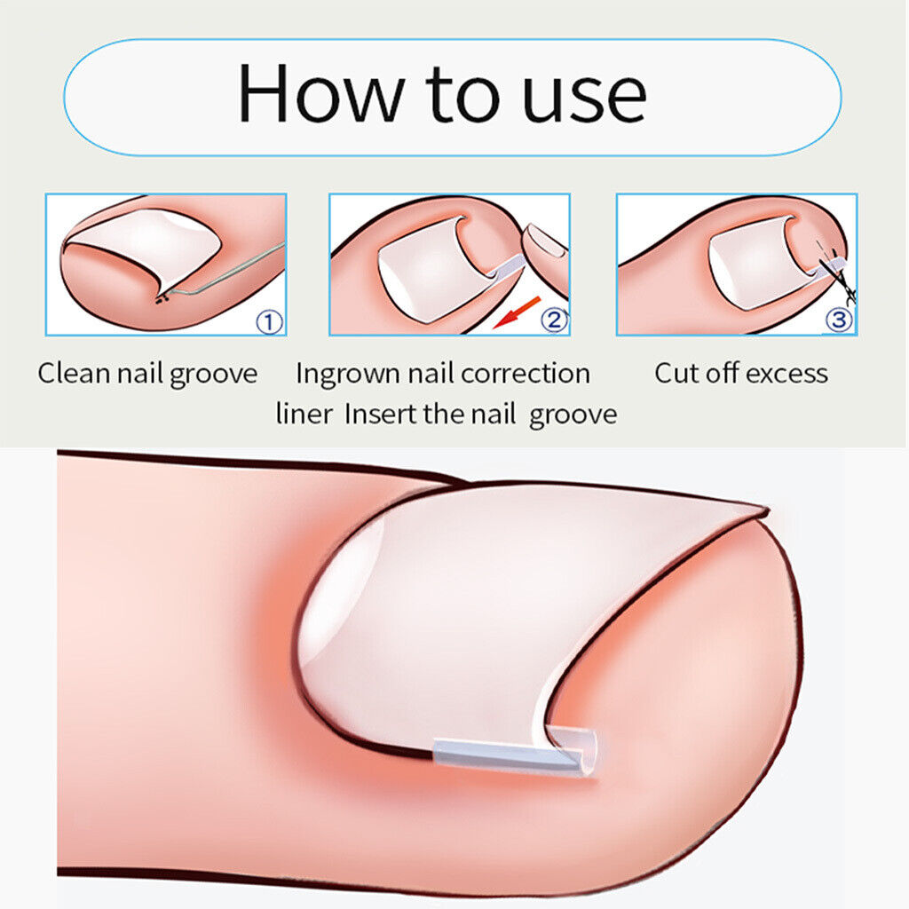 Ingrown Toenail Correction Tools Toe  Cleaner Tool 50 Liner