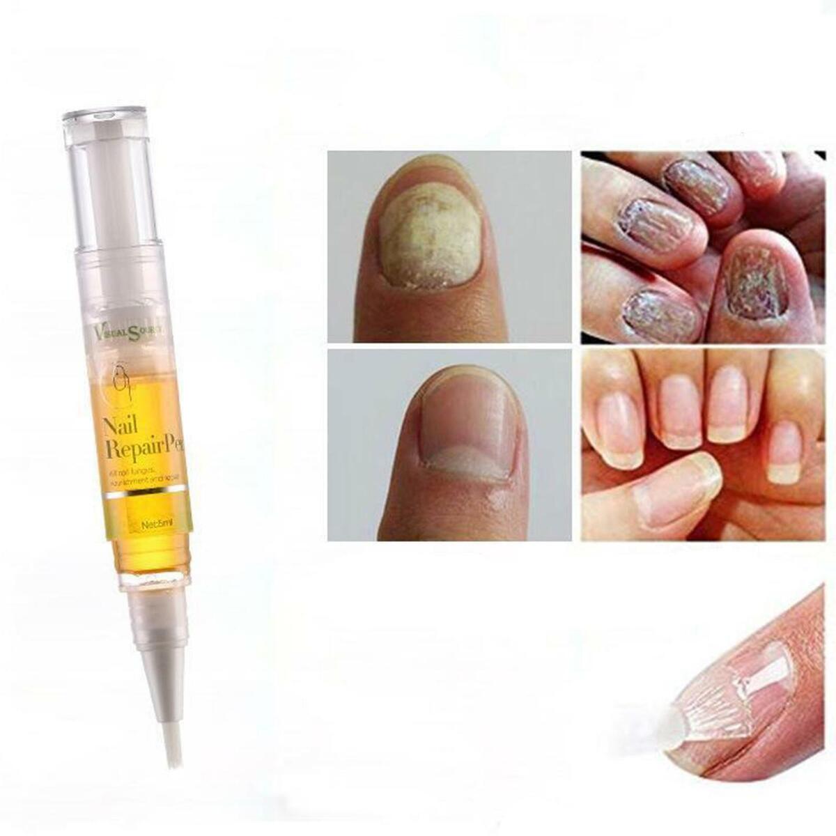 Nail   Treatment Toenail/Fingernail  Solution   Stop Nail