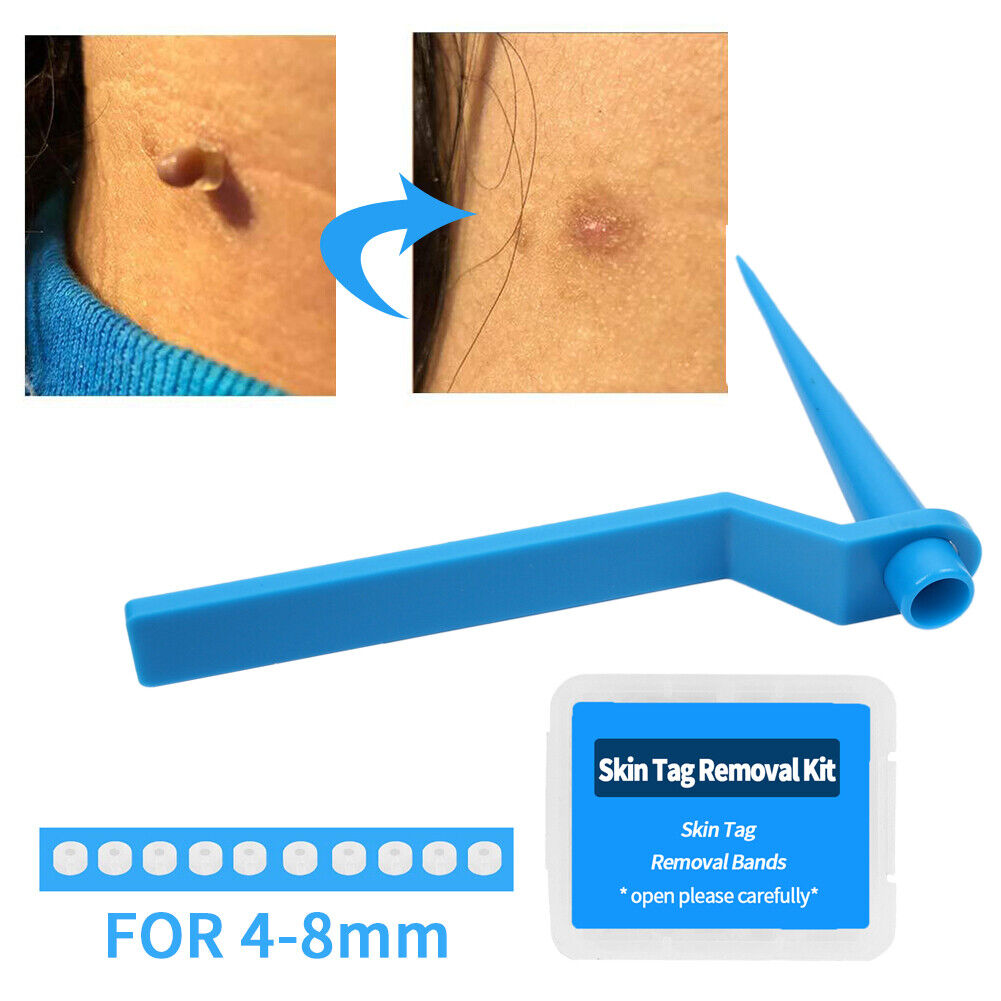 Skin Tag Remover Large Mole Wart with Removal Bands Cleansing Wipes (Blue)