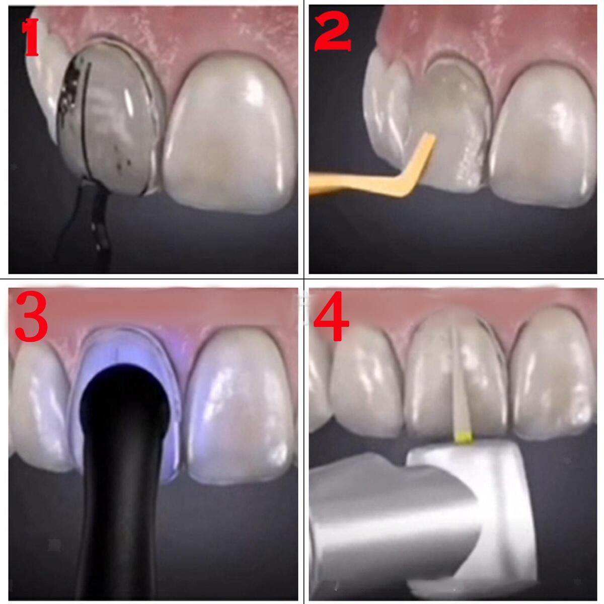 30 Pieces Teeth Beauty Veneers Anterior Front Teeth Aesthetic Practical
