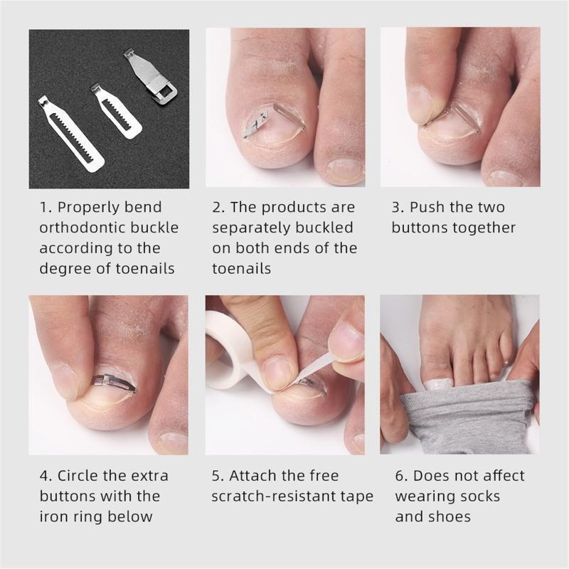 Ingrown Toenail Pedicure Tool Straightening Clip Curved Clips Tape for Toenails