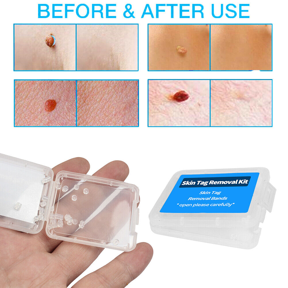 30pcs Skin Tag Remover Patch Kits Easy Clean Face Mole Band for Home Use