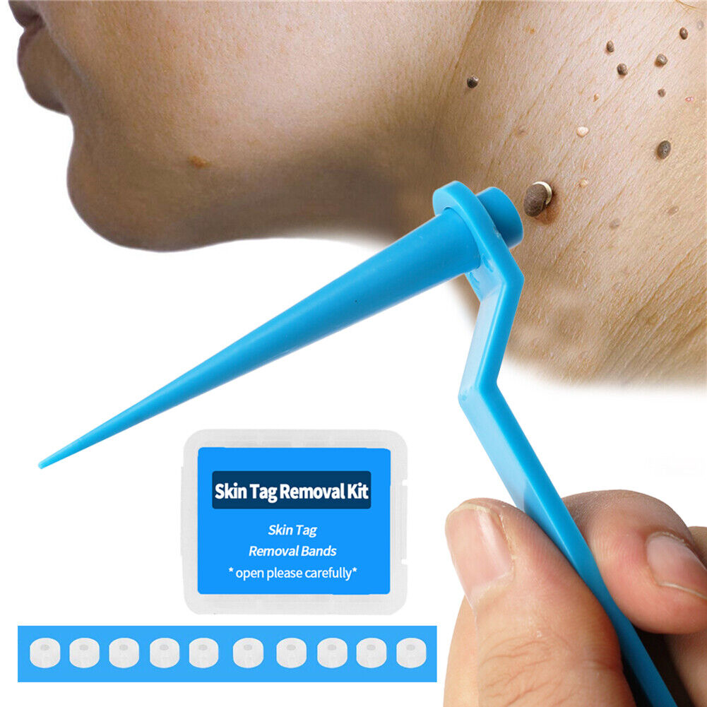 Skin Tag Remover Large Mole Wart with Removal Bands Cleansing Wipes (Blue)