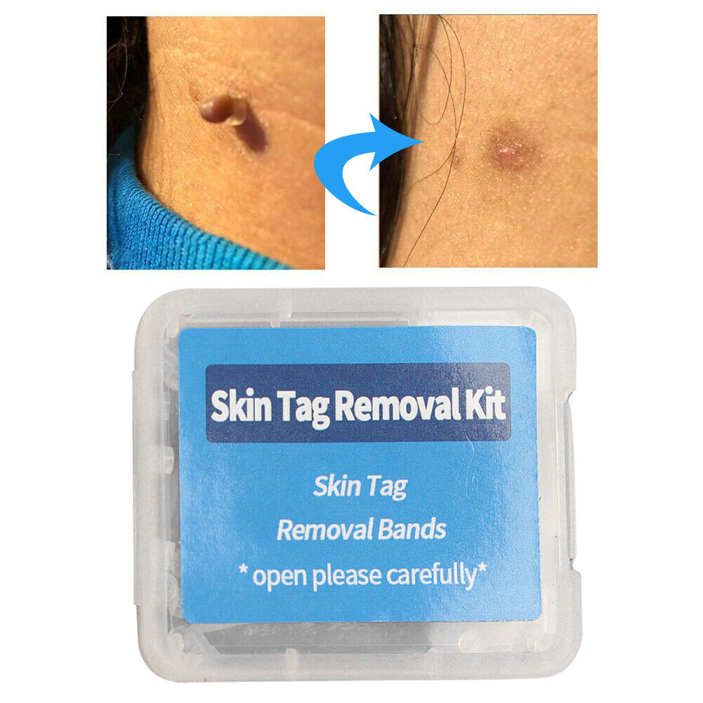 Skin Tag Removal Ring Rubber Bands Kit Acne Pimple Blemish Treatment Tools