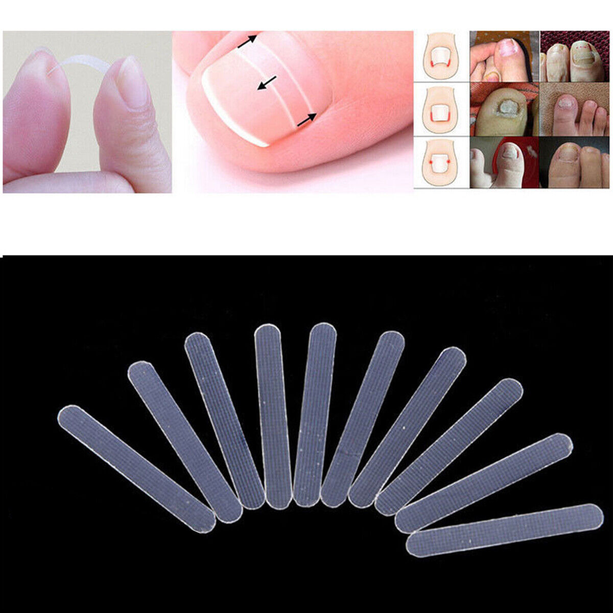10pcs  Ingrown Toenail Straightening Clip Curved Brace Treatment Tool With Glue