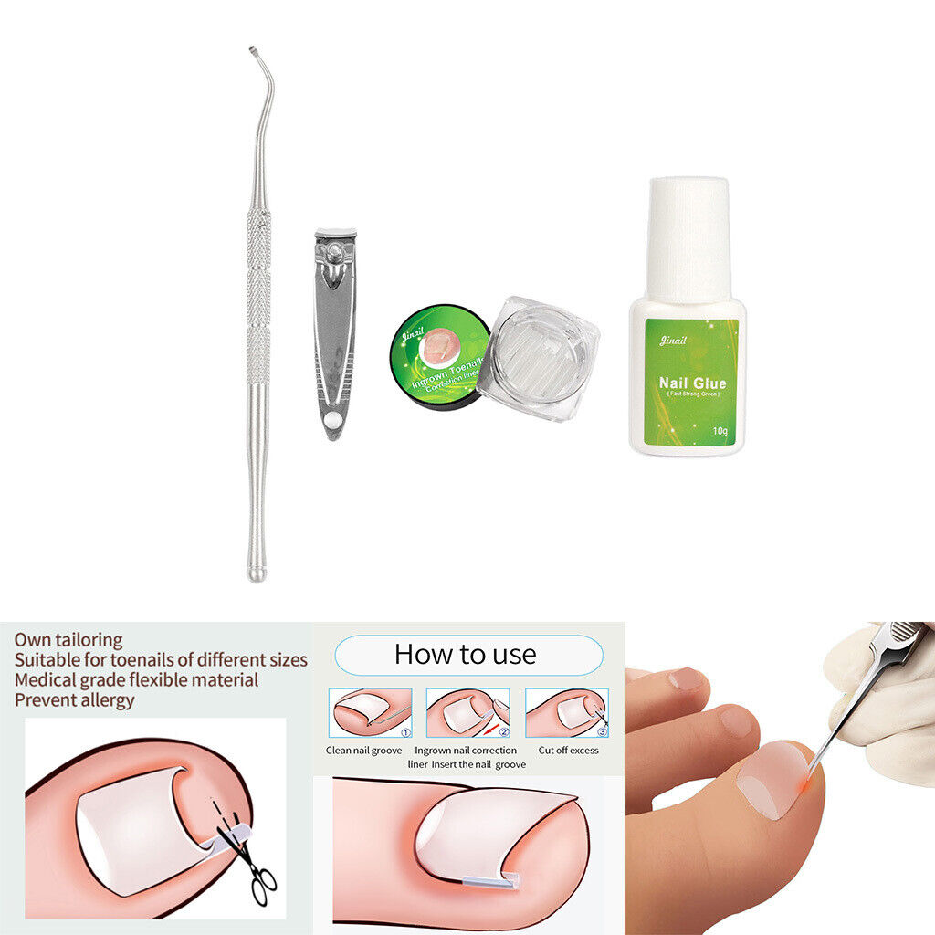 Ingrown Toenail Correction Tools Toe  Cleaner Tool 50 Liner