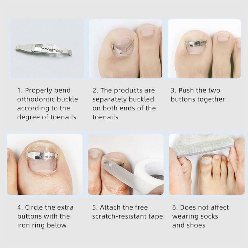 Paronychia Toe Nail Corrector Ingrown Toenail Straightening Correction