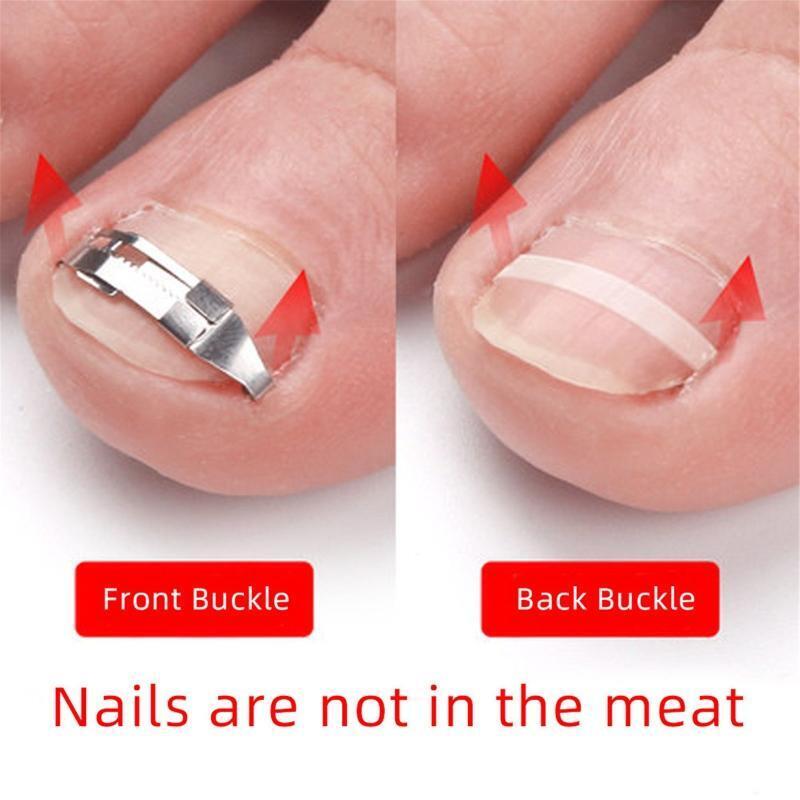 Ingrown Toenail Pedicure Tool Straightening Clip Curved Clips Tape for Toenails