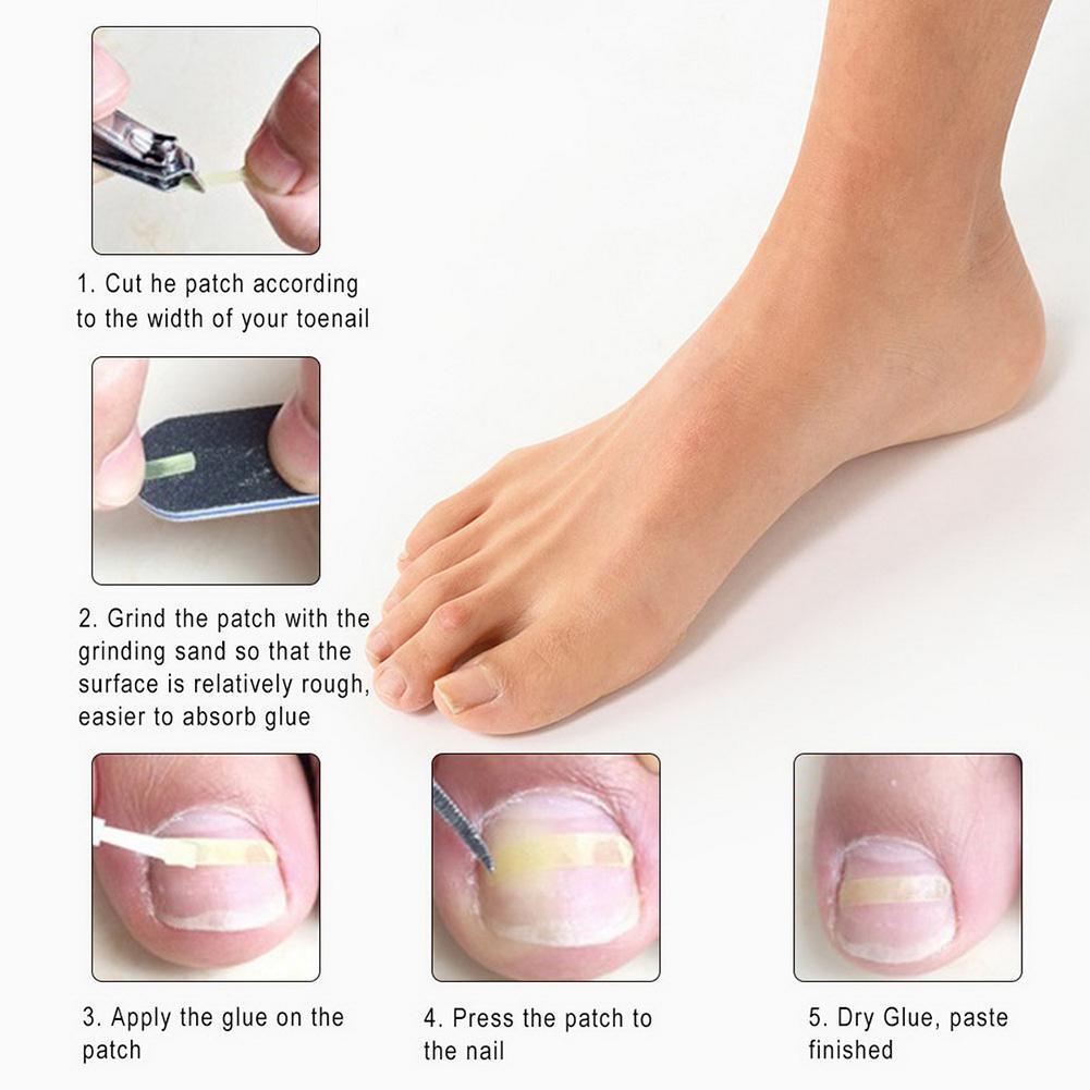 Ingrown Toenail Straightening Clip+Glue+Polish File Curved Brace Patch Kit