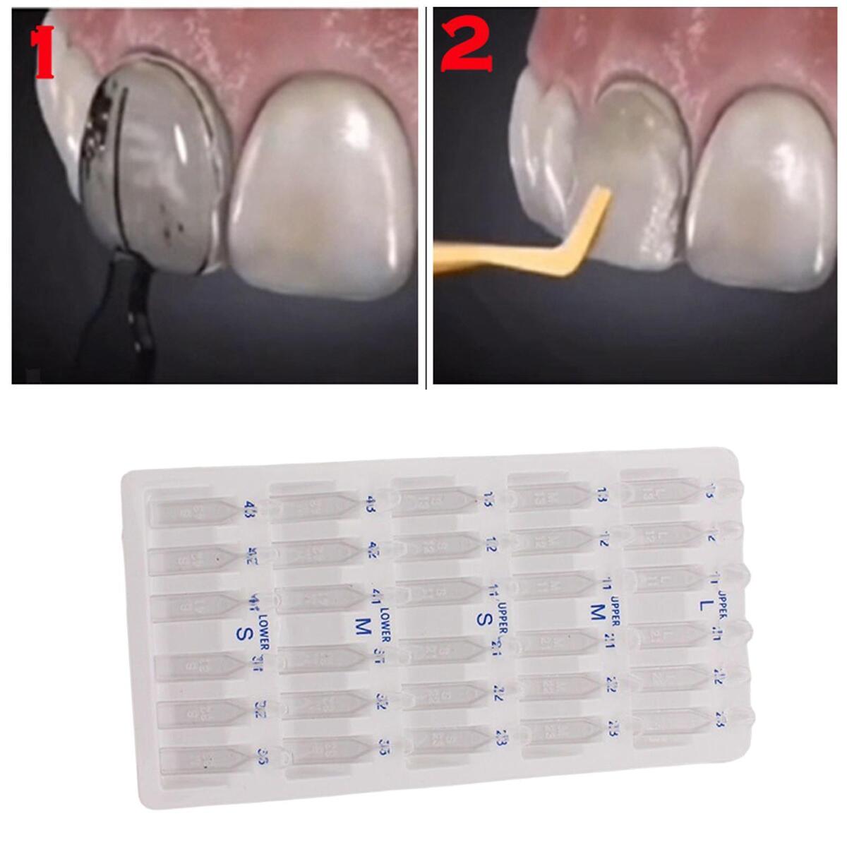 30x Dental Veneers Teeth Whitening Tool Quick Forming Autoclavable Practical
