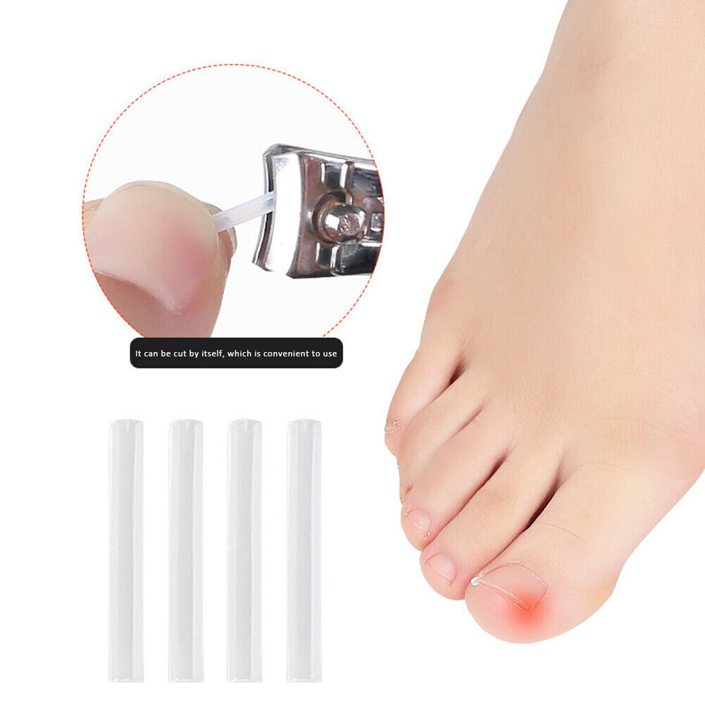 Ingrown Nail Filling Pad Relief Pain Nail Corrector Groove Pads (20pcs)