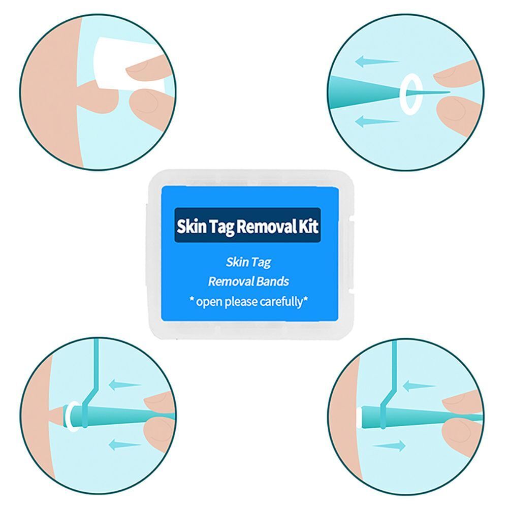 Care Tools Face Care Mole Wart Removal Rubber Bands Micro Band Skin Tag Removal
