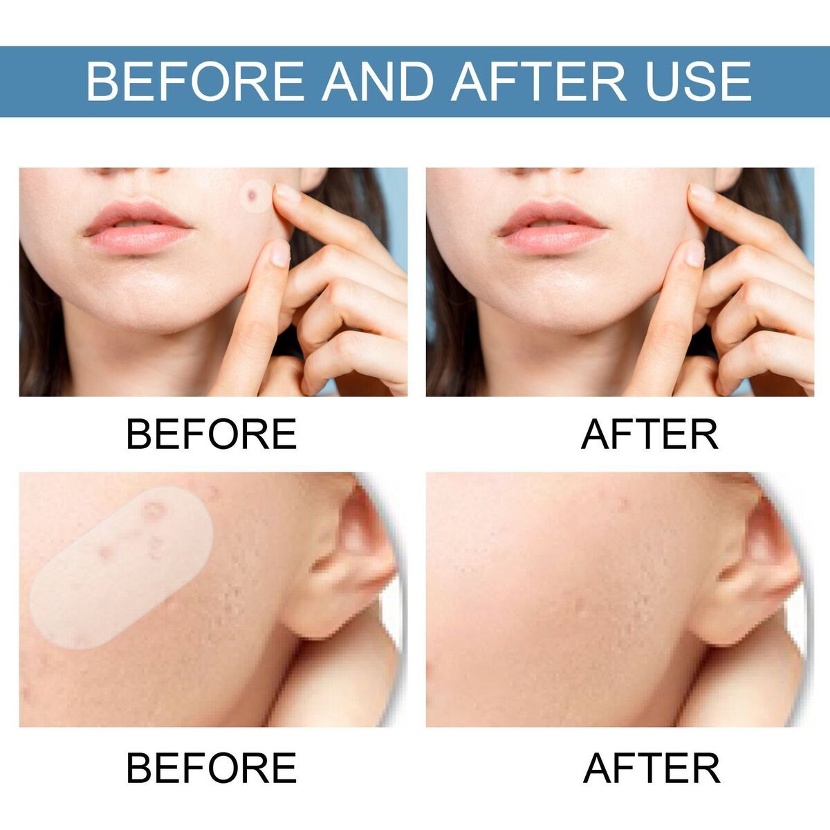 Master Acne Spot Treatment Skin Tag Remover Patch Ance Pimple Patches