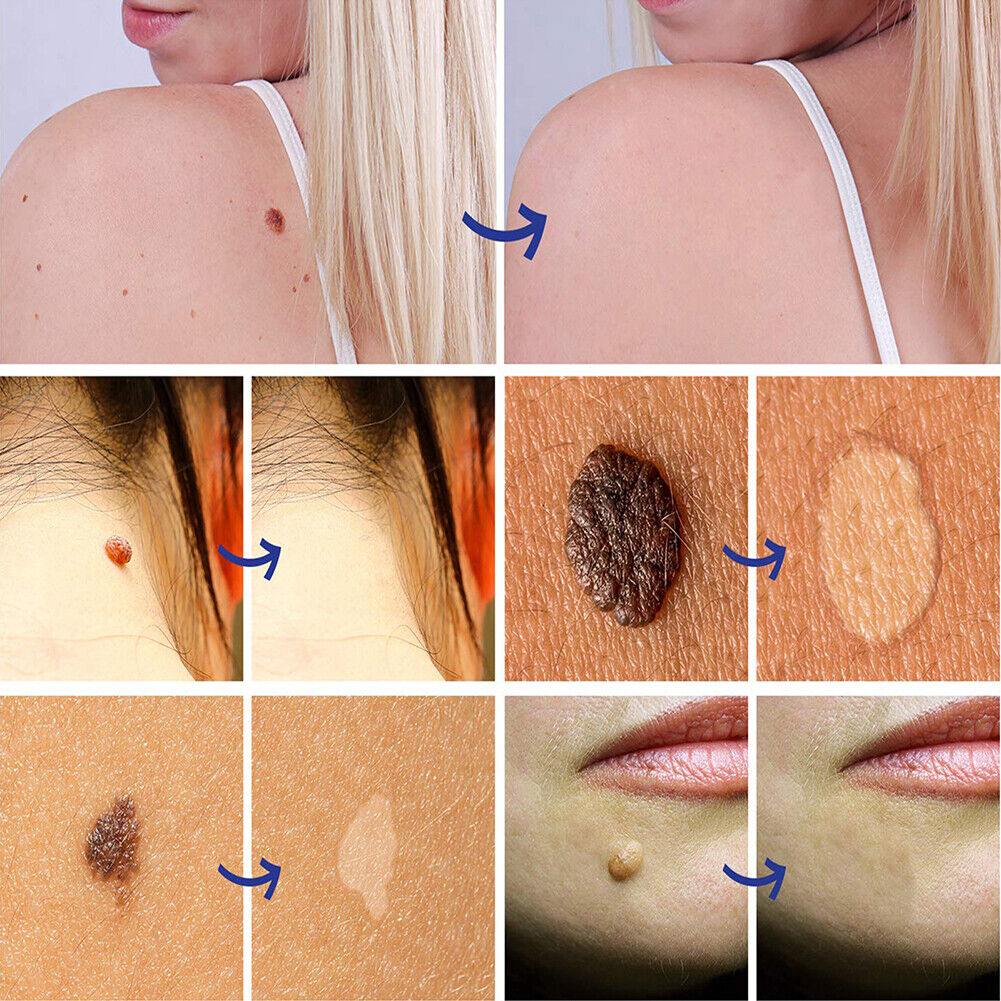 Portable Skin Tag Remover Pen Patch Wart Remove Acne Mole Treatment Tool