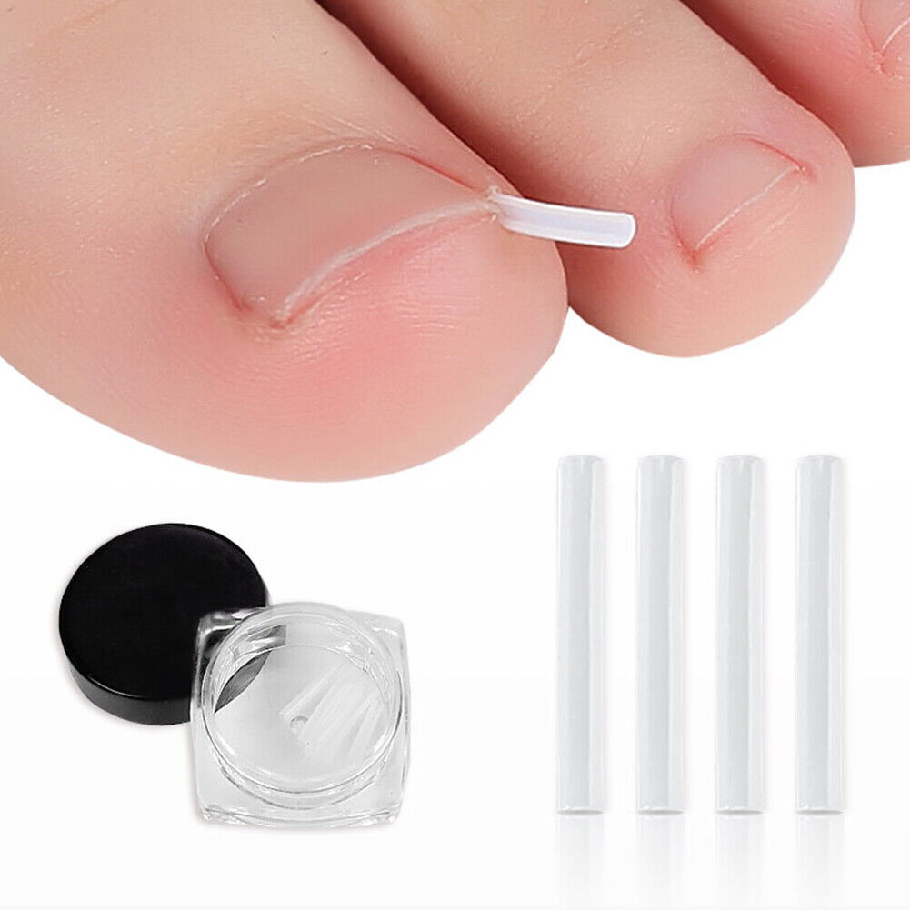 Ingrown Nail Filling Pad Relief Pain Nail Corrector Groove Pads (20pcs)