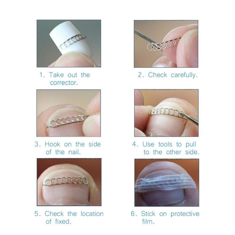 Stainless Steel Ingrown Toe Nail Wire Fixer Pedicure Recover Toenail Corrector