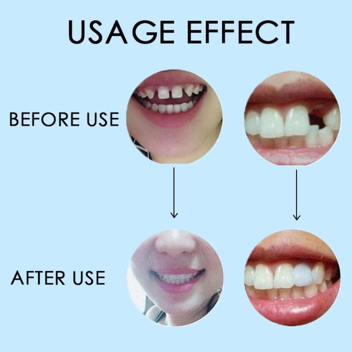 Replacement Thermal   Veneers  Temporary  Repair Kit