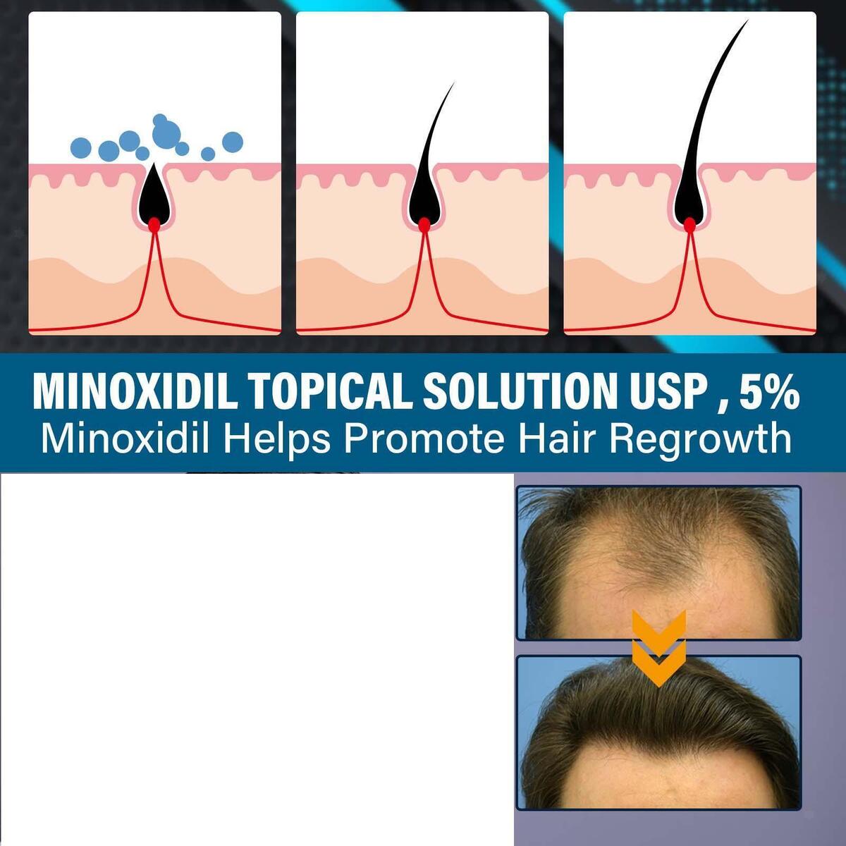Hair Growth Essence Spray Anti Hair Loss Fast Grow for Prevent Hair Loss