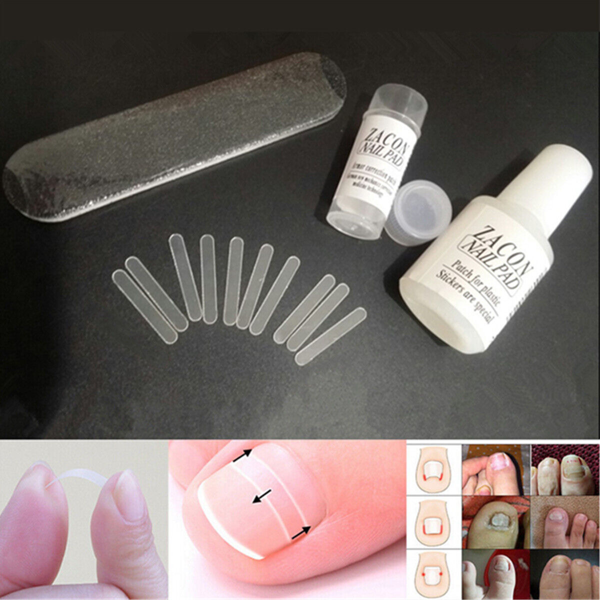 10pcs  Ingrown Toenail Straightening Clip Curved Brace Treatment Tool With Glue