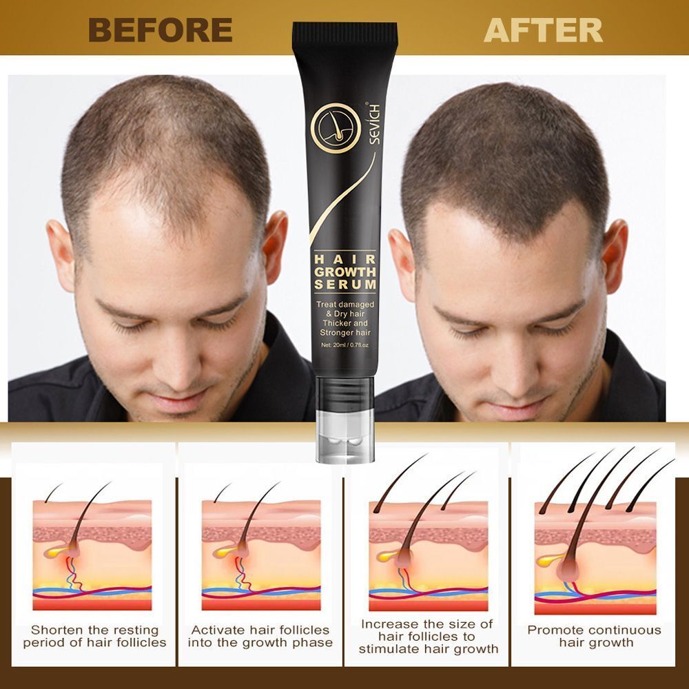 Serum Roller Scalp Massage Anti Hair Loss Hair Growth Essence Oil Thickener