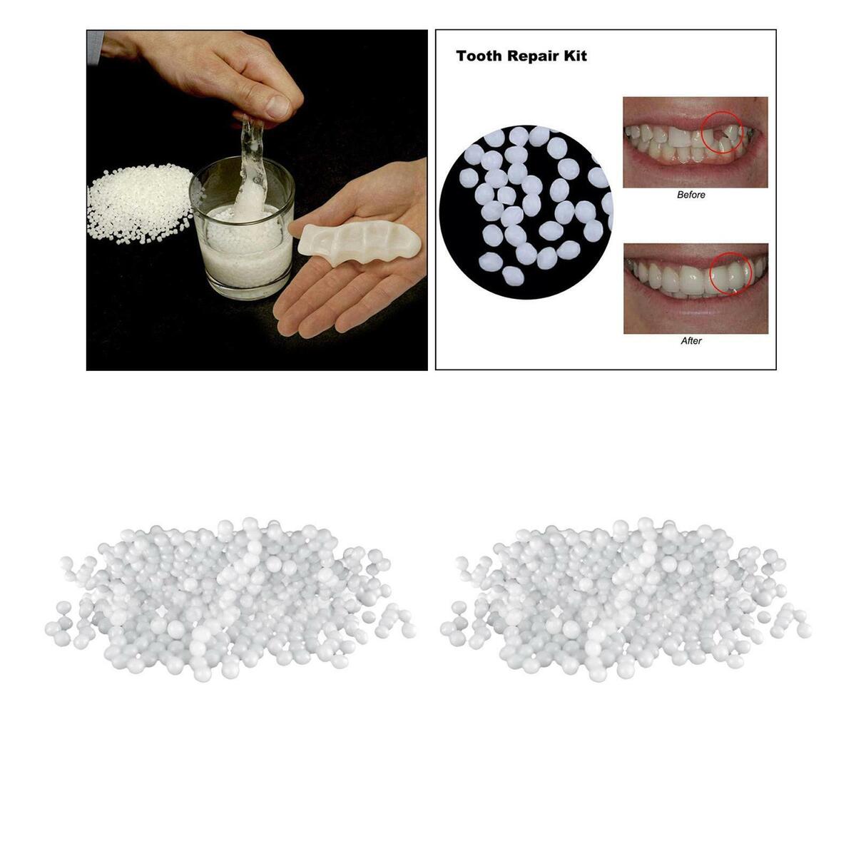 Thermal Fitting   Veneers Moldable Temporary  Repair Kit