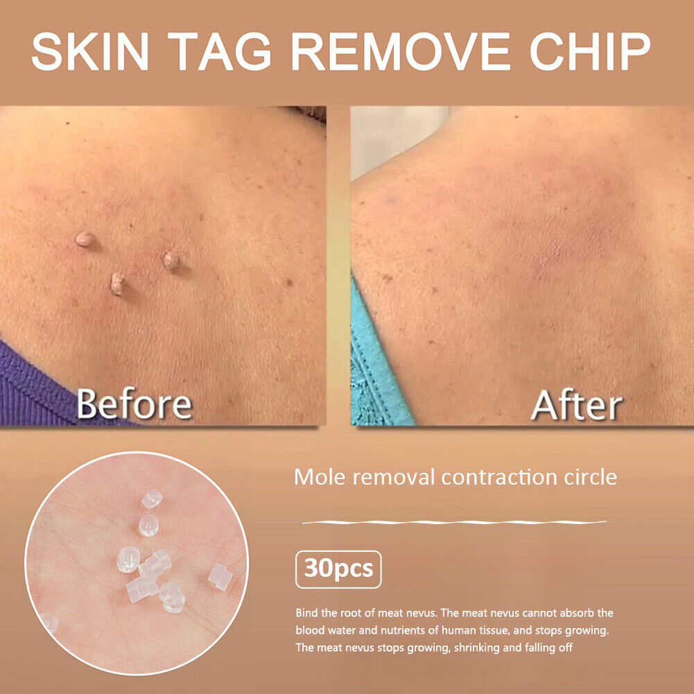 Skin Tag Removal Ring Rubber Bands Kit Acne Pimple Blemish Treatment Tools