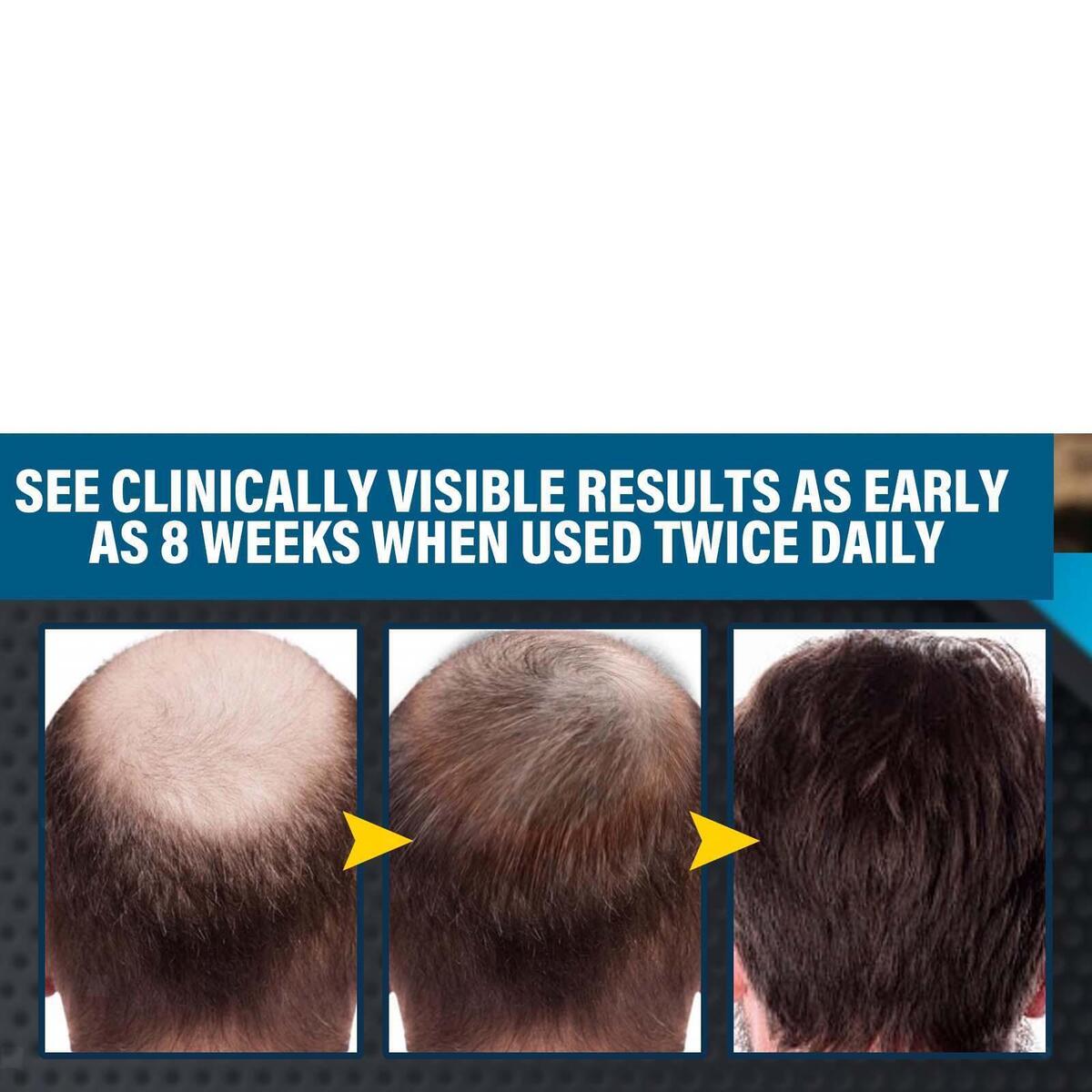 Hair Growth Essence Spray Anti Hair Loss Fast Grow for Prevent Hair Loss