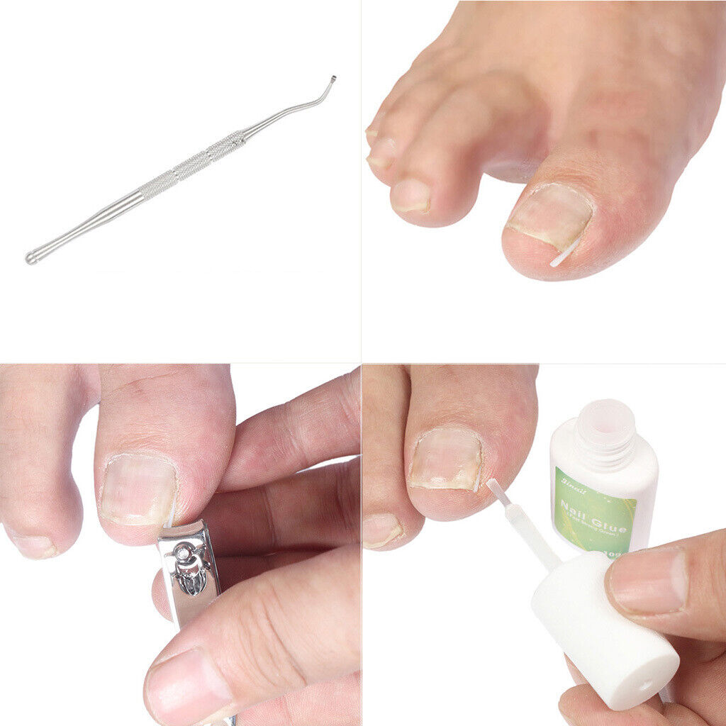 Ingrown Toenail Correction Tools Toe  Cleaner Tool 50 Liner