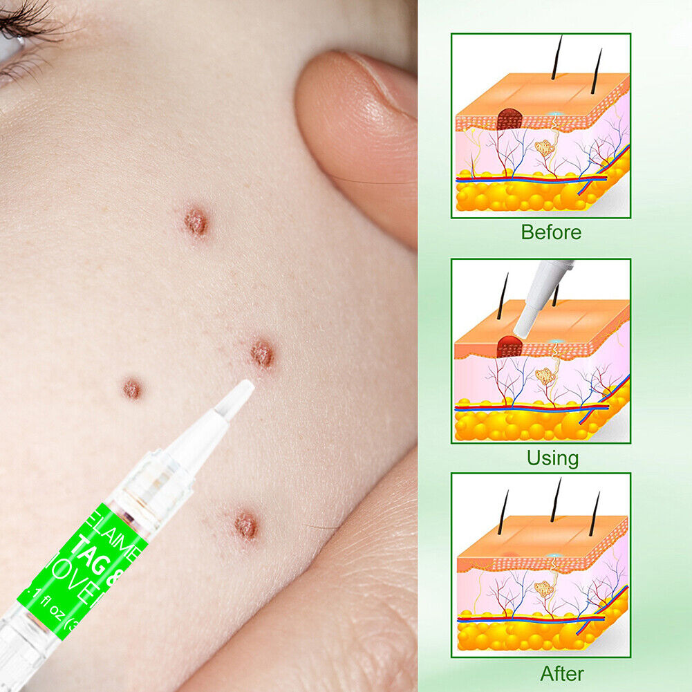 Portable Skin Tag Remover Pen Patch Wart Remove Acne Mole Treatment Tool