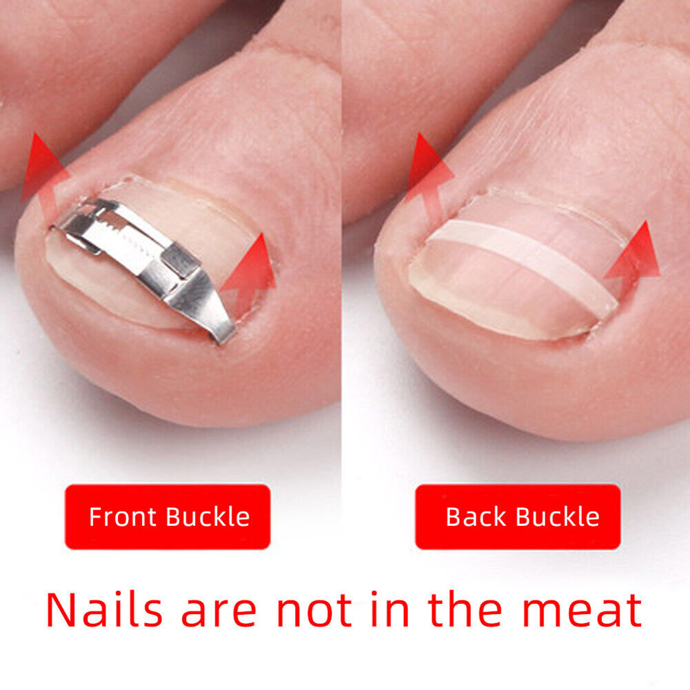 1 Pair Ingrown Toe Nail Fixer Embed Toenail Correction Lifter Pedicure Tool