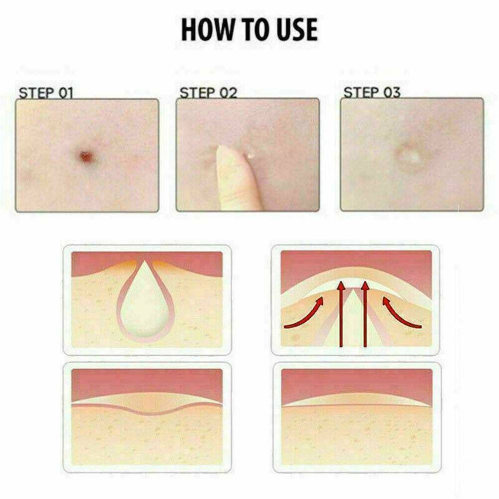 72PCS DERMOPATCHY ACNE SKIN TAGS PIMPLE REMOVER PATCH REMOVAL FACIAL CARE SPOT !