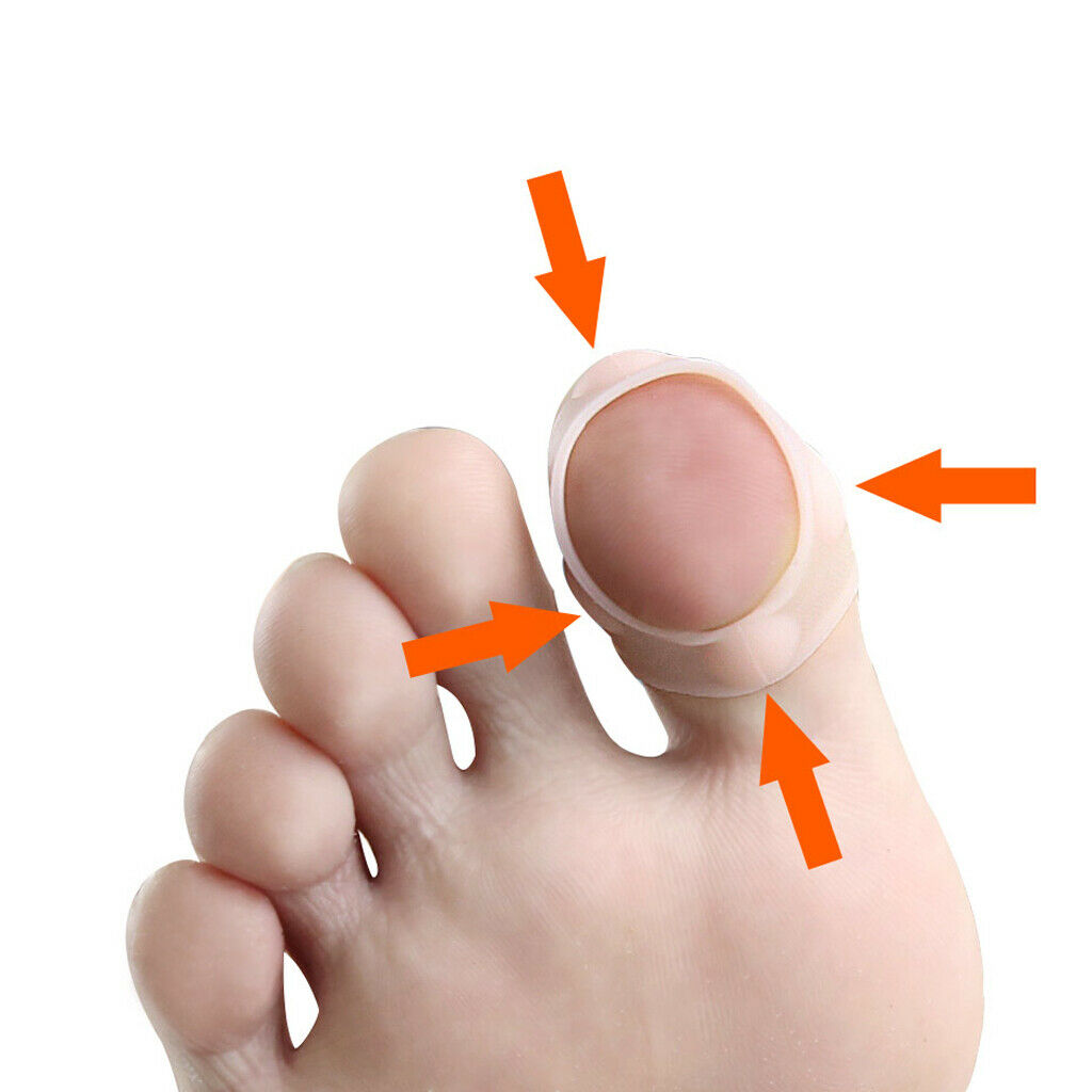 5 Pairs Silicone Ingrown Toenail Corrector Pedicure Tools for Men Women