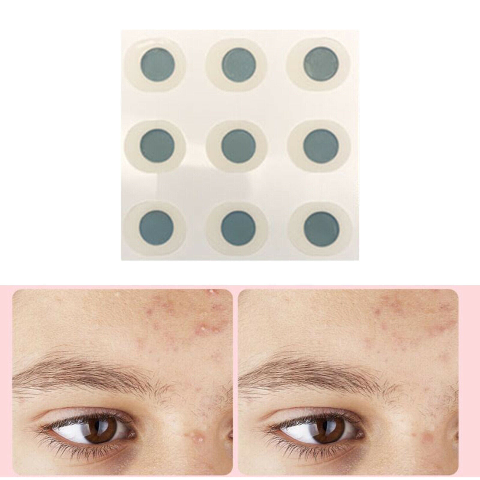 Acne Patch Blemish Spot 9 Count for Microcrystal Face Skin ,