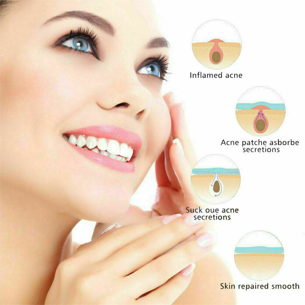 36Pcs Remover Patch Stickers Acne Set Pimple Master Treatment Skin Care Tools