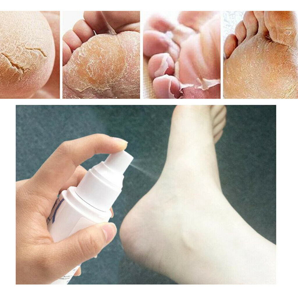 Foot Callus Remover Sprayer, Works well with foot scrubber, file, pumice stone