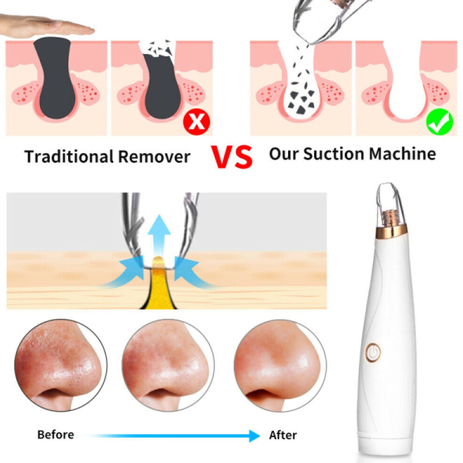 1pc Electric Pore Cleaner Vacuum Blackhead Remover Face Pore Suction Cleaner
