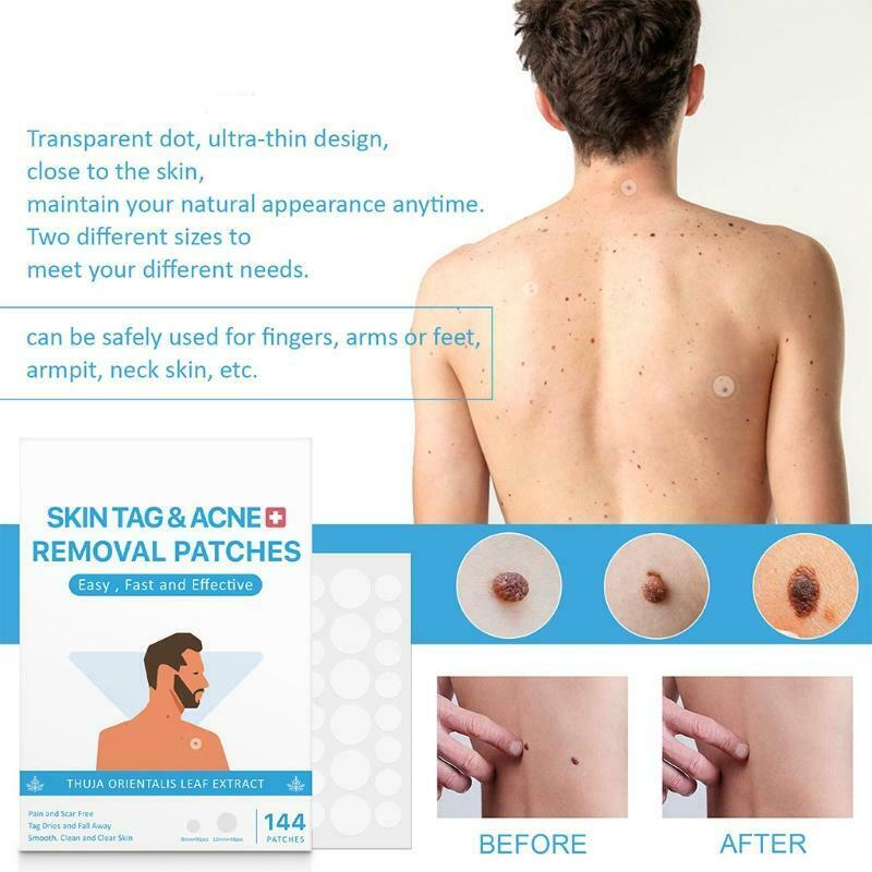 Skin Tag Remover Patches Repair Lotion Set Wart Remover Patches Fast Healing