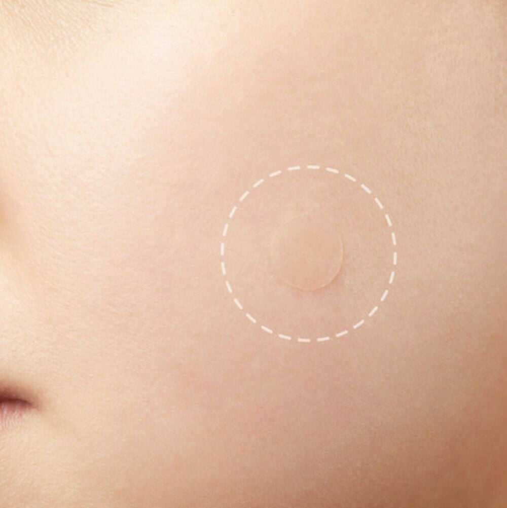 Skin Tag & Acne Patch - Hydrocolloid Acne and Skin Tag Remover Patches - 36 Pcs