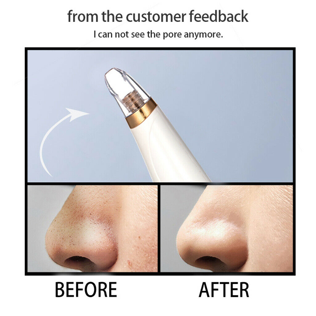 62kPa Blackhead Blemish Remover Extractor Lifting Firming Tightening Device