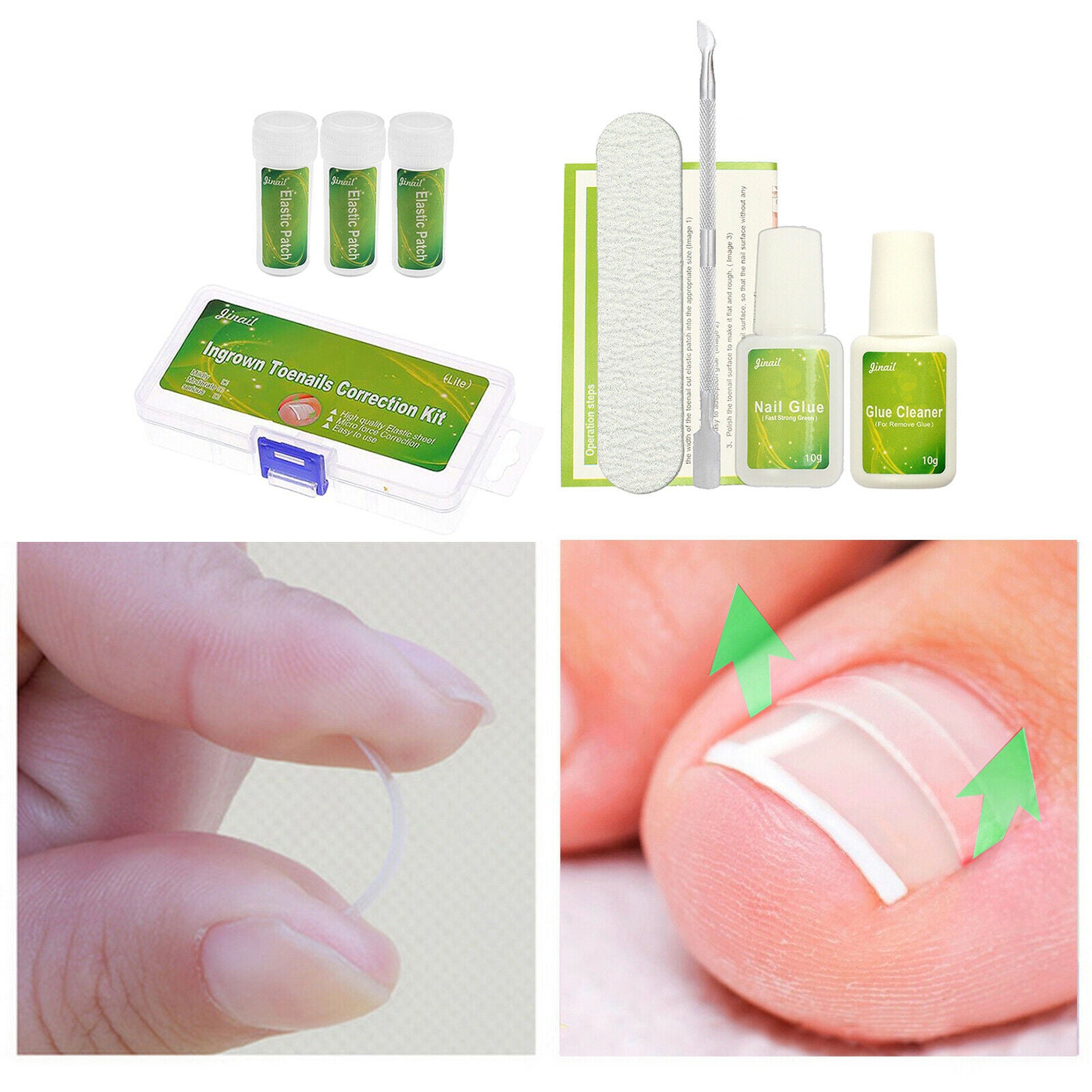 Ingrown Toenail Correction Tool Ingrown Toe Nail Pedicure Patch Straightening