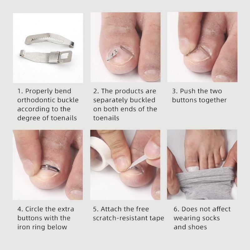 Toenail Fixer Foot Care Tool Paronychia File Patch Corrector Tool Toenail Care