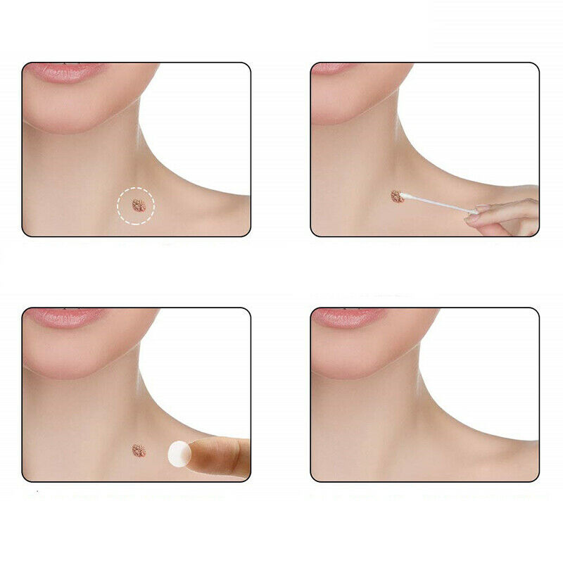 Skin Tag Remover Patch Ance Pimple Patch Anti-infection Quick Absorb Face.l8