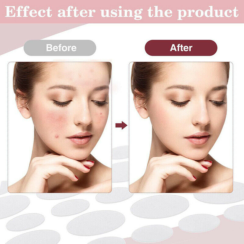 36pcs Acne Pimple Patch Acne Removal Stickers Blemish Treatment Face Skin.l8